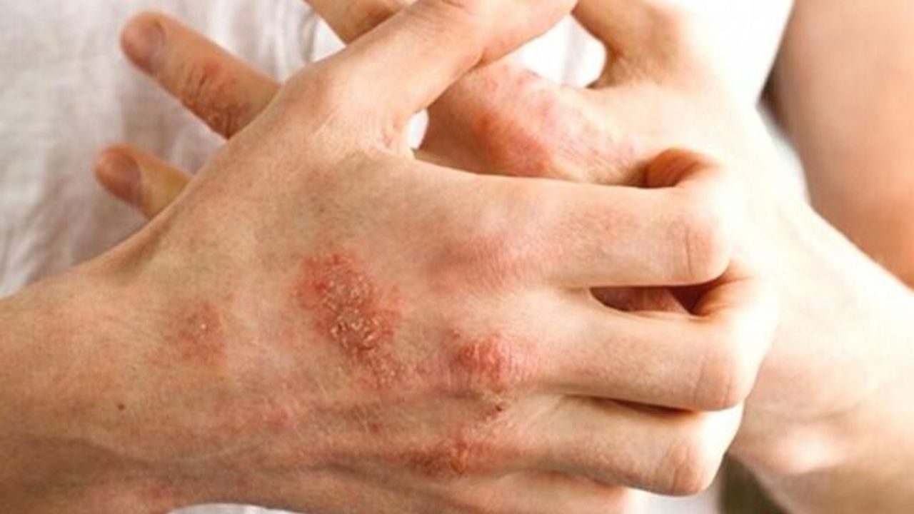 Egzamanın en önemli ve en rahatsız edici belirtisi şiddetli kaşıntı