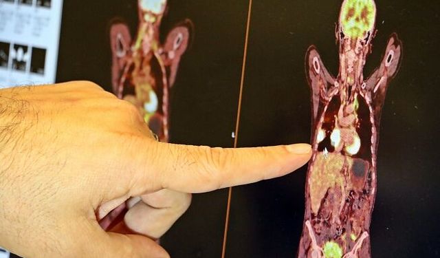 "Akciğer kanseri tedavisinde sağ kalım oranları artıyor"