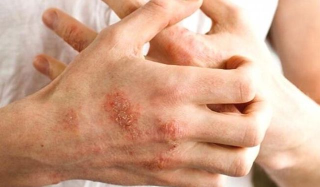 Egzamanın en önemli ve en rahatsız edici belirtisi şiddetli kaşıntı