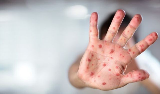 5 yaş altı çocuklar risk altında